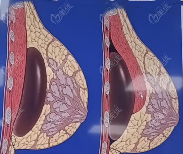 假体隆胸后趴床姿势图片