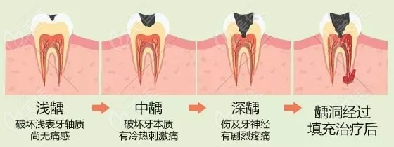 牙齿龋坏用哪种补牙材料修复比较好