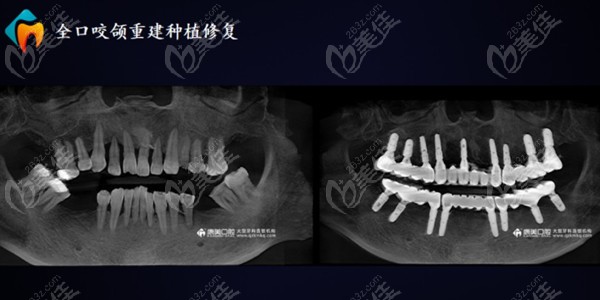 廖勇医生全口种植牙病例