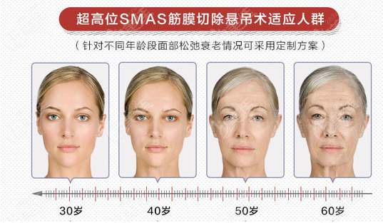 超高位SMAS筋膜切除悬吊术适合人群