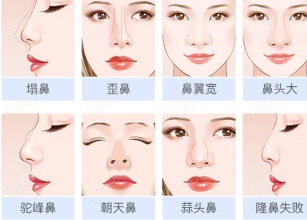 上海美联臣刘双立医生可以可以修复哪些鼻子类型