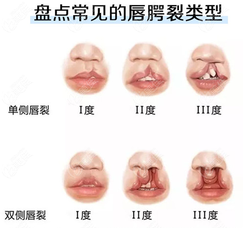 唇腭裂不同类型
