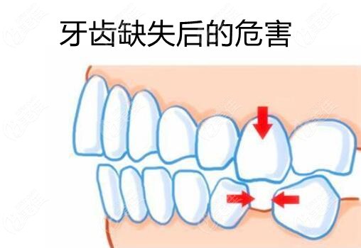 因为缺牙时间久了之后,不仅对颌牙会伸长,缺失位两边的牙齿也会向中间