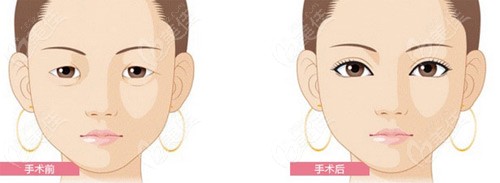 在南京华美做的去眼袋对比照