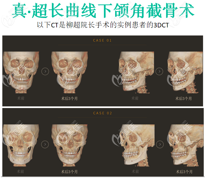 广州韩妃柳超下颌角截骨手术病例ct对比图