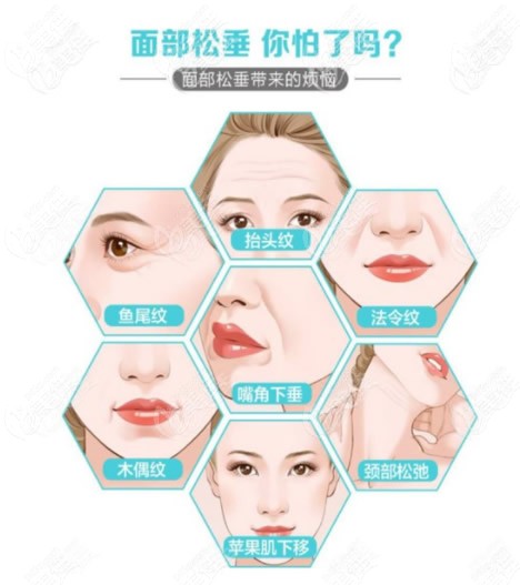 面部小切口拉皮提升适合哪些人做