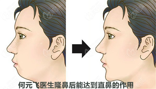 何元飞医生做隆鼻后能达到直鼻的样子