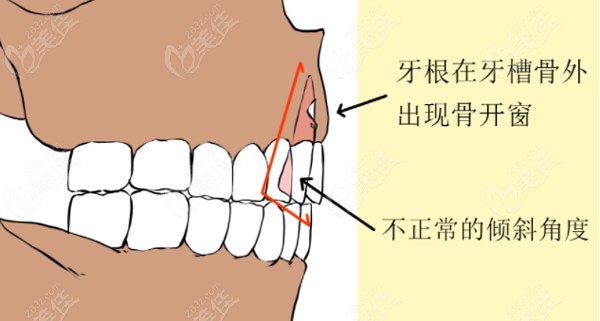 骨开窗