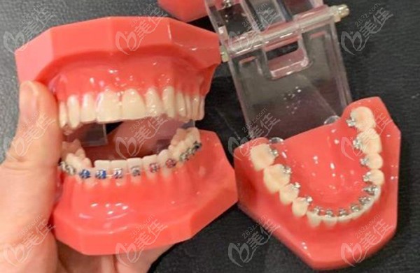 正畸paoo手术是什么