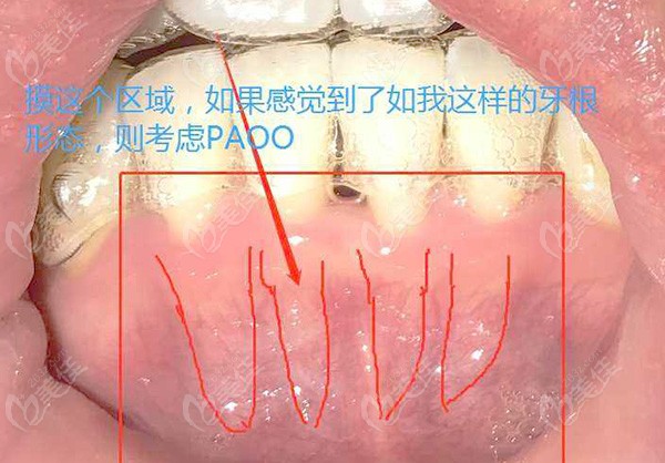 paoo可以預防牙槽骨吸收嗎從paoo的作用與術後牙齦變化來看