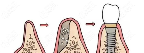 paoo不能预防牙槽骨吸收