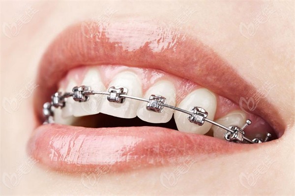 paoo牙周辅助加速成骨正畸治疗技术