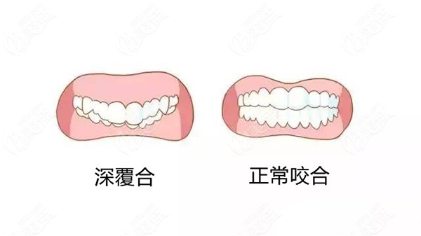 什么是深覆合