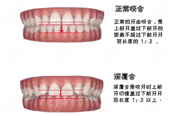 戴牙套反而整成了深覆合