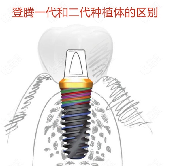 韩国登腾二代和登腾一代种植体有什么区别对比价格及优点