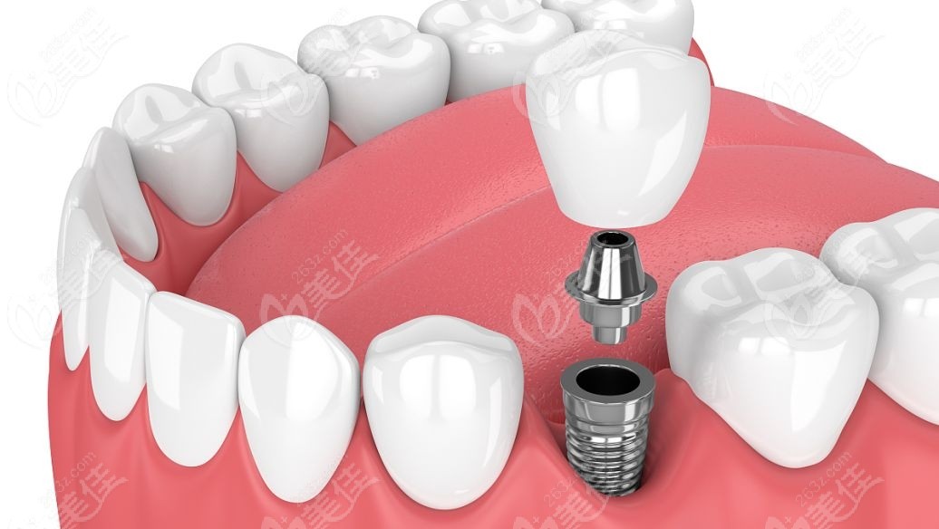 韩国登腾（dentium）种植牙