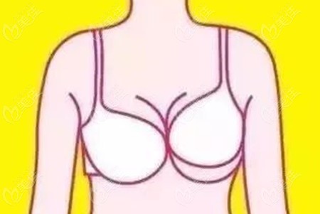 假体隆胸术后胸部高低不一致
