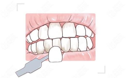 牙齿贴面对医生的要求比较高