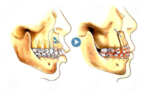 牙槽骨突出手术过程图图片