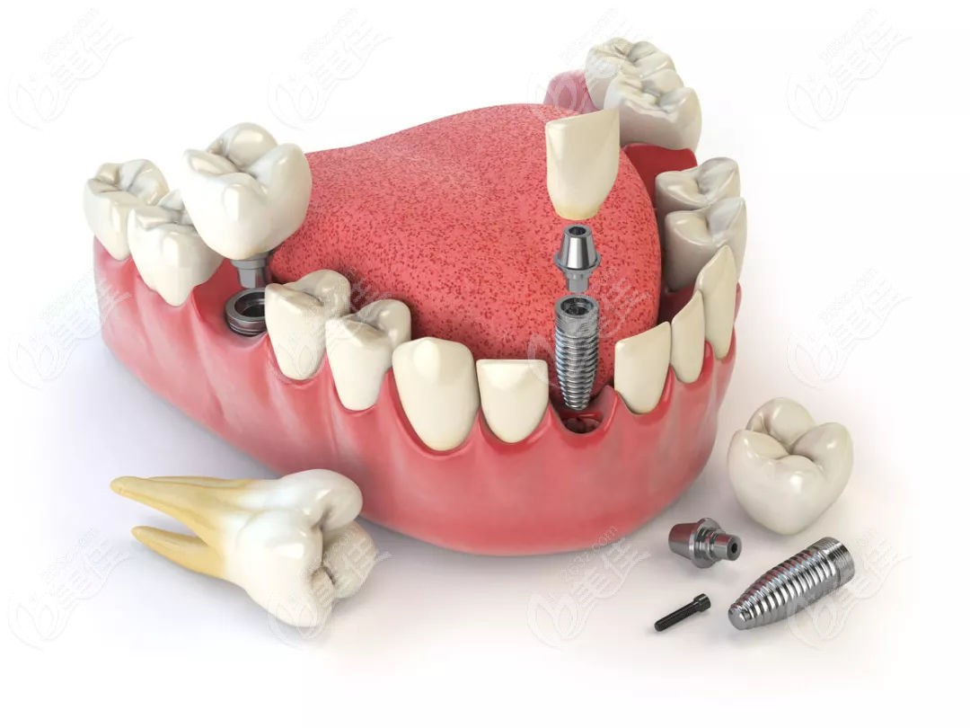 半固定和固定种植牙的区别
