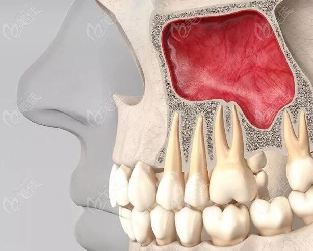 種植牙為什麼要做上頜竇提升詳情看上頜竇提升適應症及費用