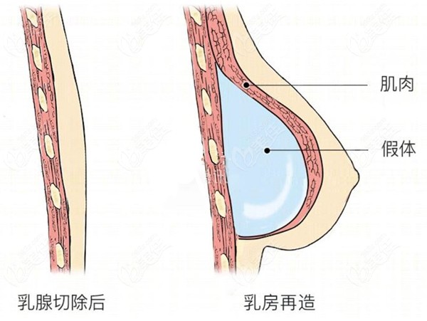 隆胸失败对比图片