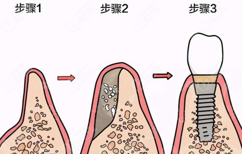 种植牙中gbr与gtr有什么区别话说gbr不需要植入骨粉骨膜哦