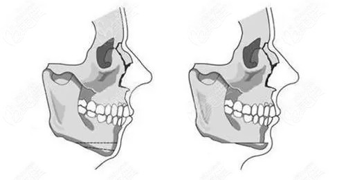 下巴后缩可以做下巴截骨前移手术