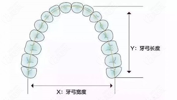 矫正扩弓器的作用是什么?正畸什么情况需要戴扩弓器呢!