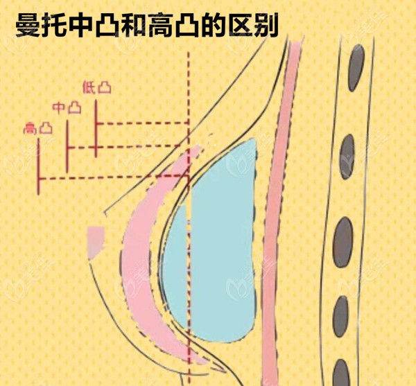 曼托假体中凸和高凸的区别