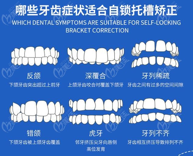 哪些牙齿症状适合自锁矫正牙套