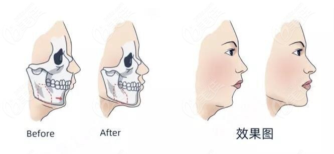 成人天包地矯正後臉型變化圖來看做正頜手術臉會不會變長費用也有