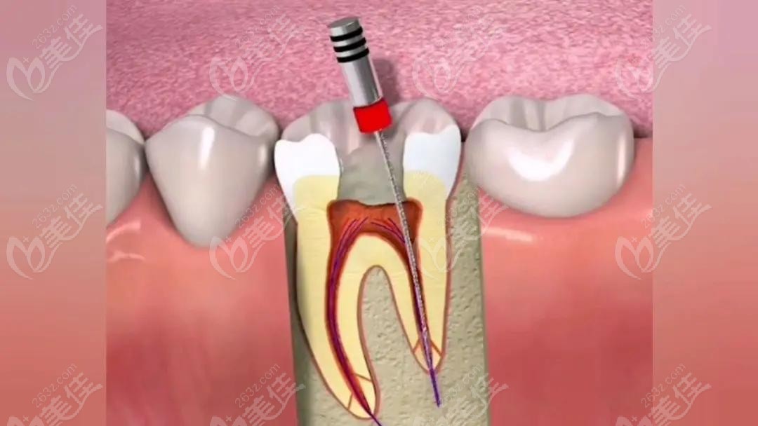 根管治疗照片图片