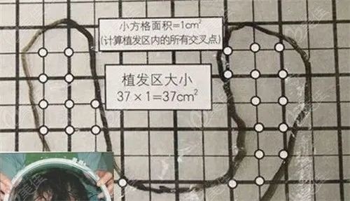 植发数量=植发面积*植发密度