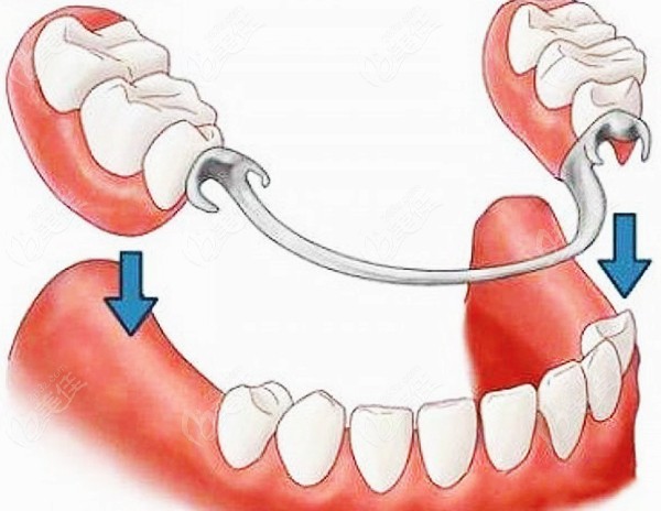 从镶牙补牙种植牙三者的区别看拔牙后选镶牙还是种牙比较好