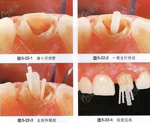 牙齿打桩的过程图片图片
