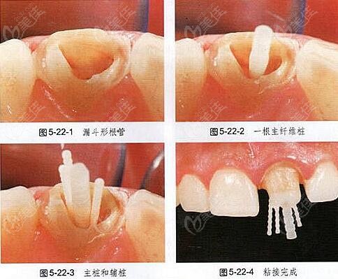 其实后牙修复选金属牙桩也够用