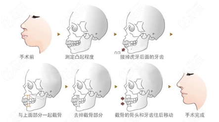 正颌手术治疗过程展示图