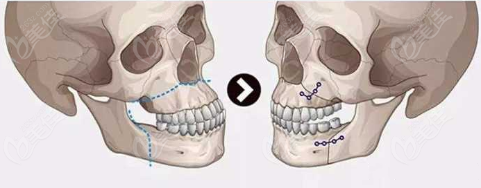治疗正颌手术过程