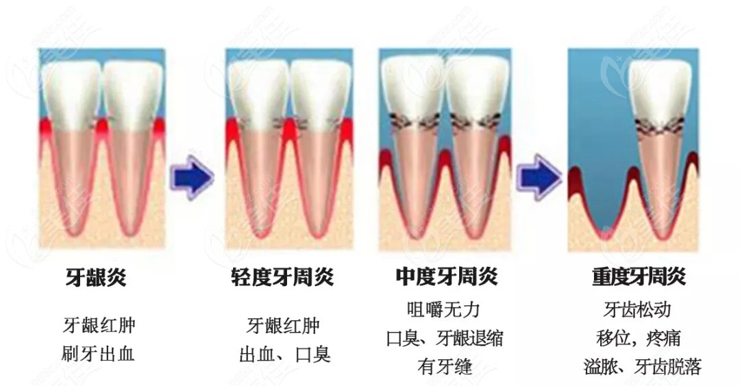  牙周深度清潔有必要做嗎_牙周深度清潔有必要做嗎