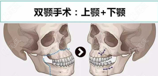 年龄大的人不太建议做正颌手术