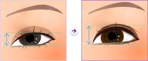 雙眼皮提肌失敗眼睛一大一小還能修復嗎手術難度高嗎