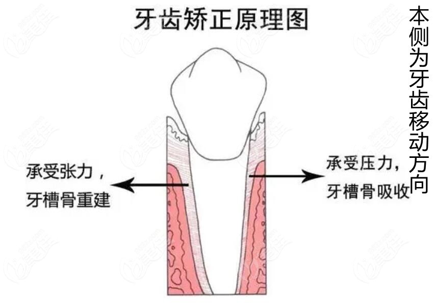 牙齿矫正原理图