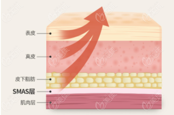 拉皮作用皮肤层次示意图