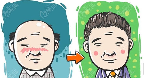 男人头顶没头发可以选择植发
