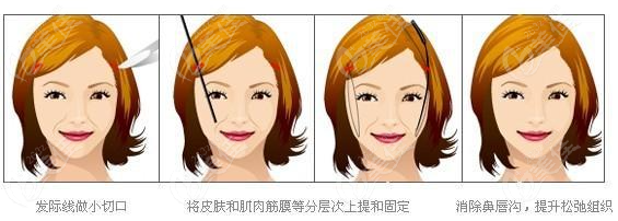拉皮手术过程操作示意图