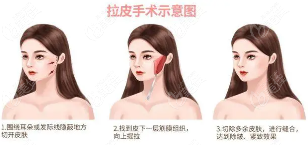 拉皮手术过程展示图
