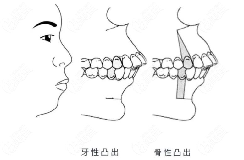 骨性凸嘴和牙性凸嘴的区别图片