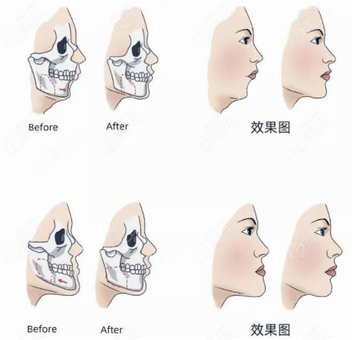 骨性嘴凸做正颌治疗对比图