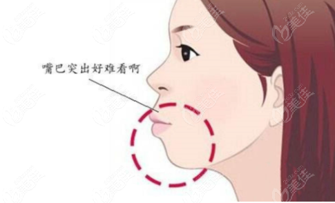 骨性嘴凸治疗方案